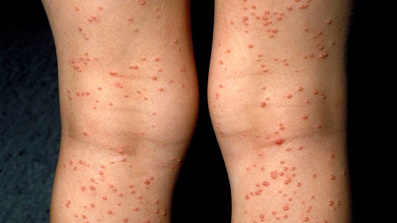 The Situation of HIV/AIDS in Mauritius